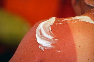 Close up of sunburn shoulders with sun cream