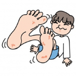 足の水泡が痛い時やかゆみがある時の原因と対処法！薬についても